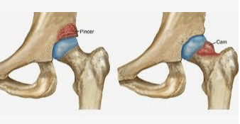 Types of Femoral Acetabular Impingement