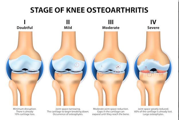 Stages of Knee Osteoarthritis