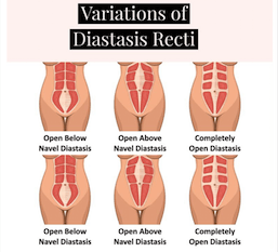 Abdominal Separation